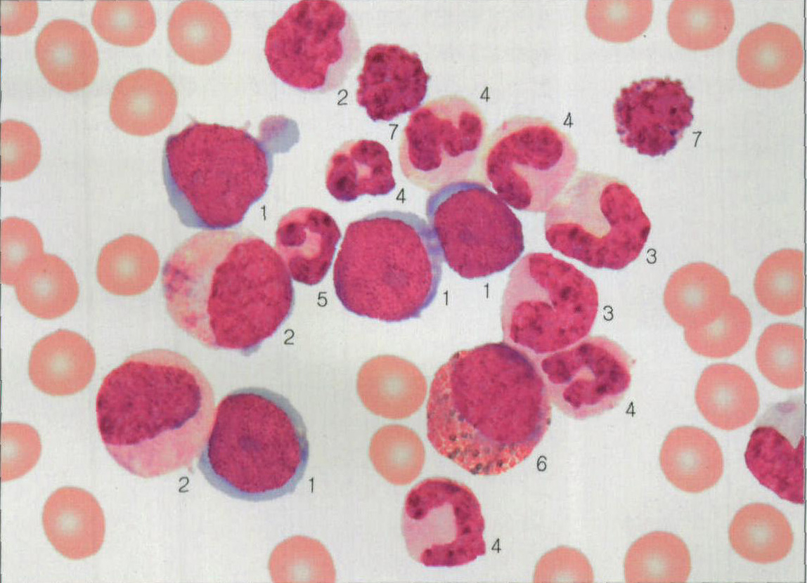 急性粒单细胞白血病